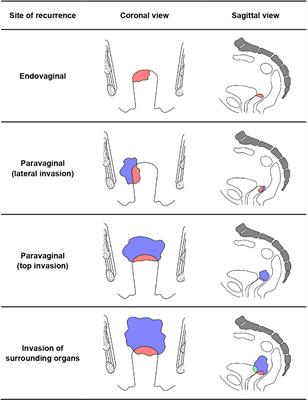 Radiotherapy for Vaginal Recurrences of Cervical Cancer in Patients After Prior Surgery: Analysis of Effect and Prognostic Factors